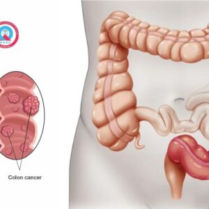 سرطان روده بزرگ
