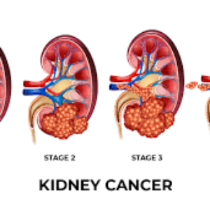 سرطان کلیه چیست؟