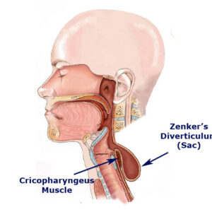 بیماری دیورتیکول زنکر چیست؟