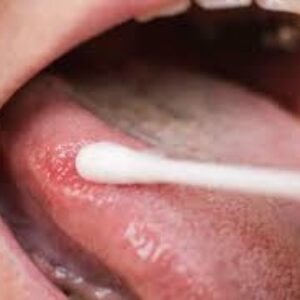 کیسه های نیکوتین و سرطان دهان