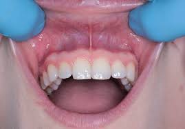 چشم انداز فرد مبتلا به سرطان لثه چیست؟
