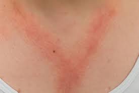 پیشگیری از اختلالات پوستی
